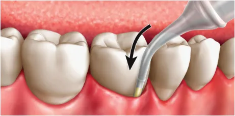 Cartridge tip insertion between tooth and gums