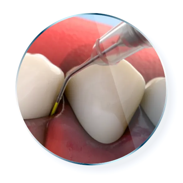 Cartridge insertion between teeth into gums