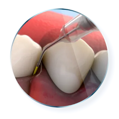 Cartridge insertion between teeth into gums