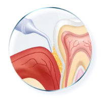 ARESTIN insertion between tooth and gum